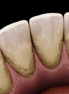 スケーリング（歯石除去）